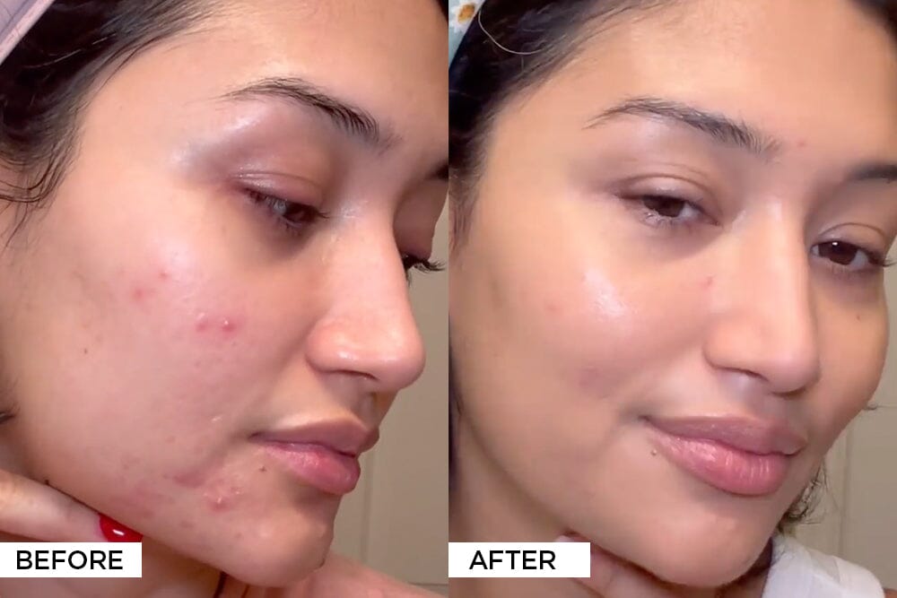 Can Makeup Actually Cause Acne?