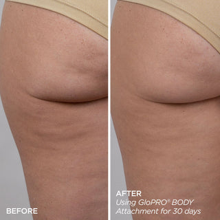 GloPRO® BODY MicroTip™