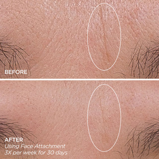 GloPRO® FACE MicroTip™