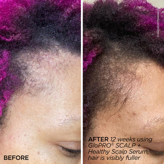 GloPRO® SCALP Attachment