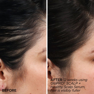 GloPRO® SCALP Attachment