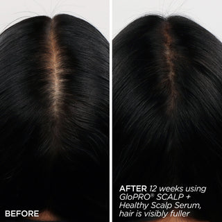 GloPRO® SCALP Attachment