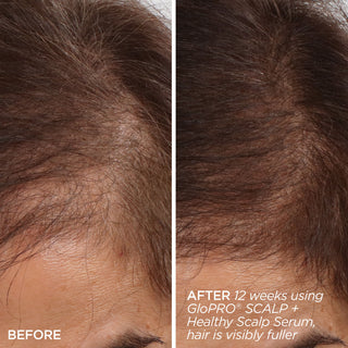 GloPRO® SCALP Attachment