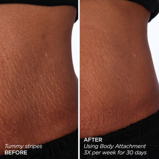 GloPRO® BODY MicroTip™