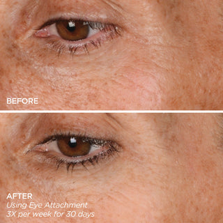 GloPRO® EYE MicroTip™