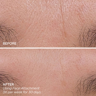 GloPRO® Facial Microneedling Tool