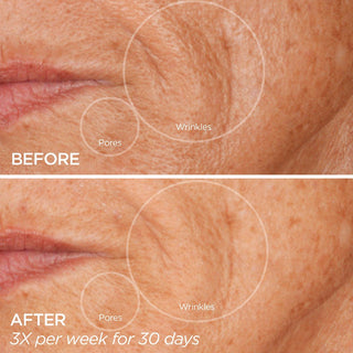 GloPRO® Facial Microneedling Tool