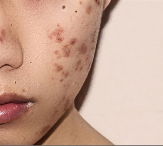 Microneedling Before and After Photos: Acne Scars Treatment