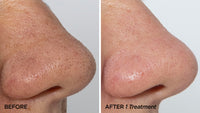 BeautyBio GLOfacial - Pore Cleansing Tool with Pro Results
