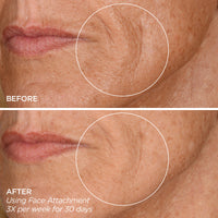 GloPRO® Facial Microneedling Tool