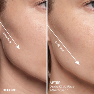 GloPRO® Cryo Roller Duo Attachments (Tool Not Included)