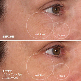 GloPRO® Cryo Roller Duo Attachments (Tool Not Included)