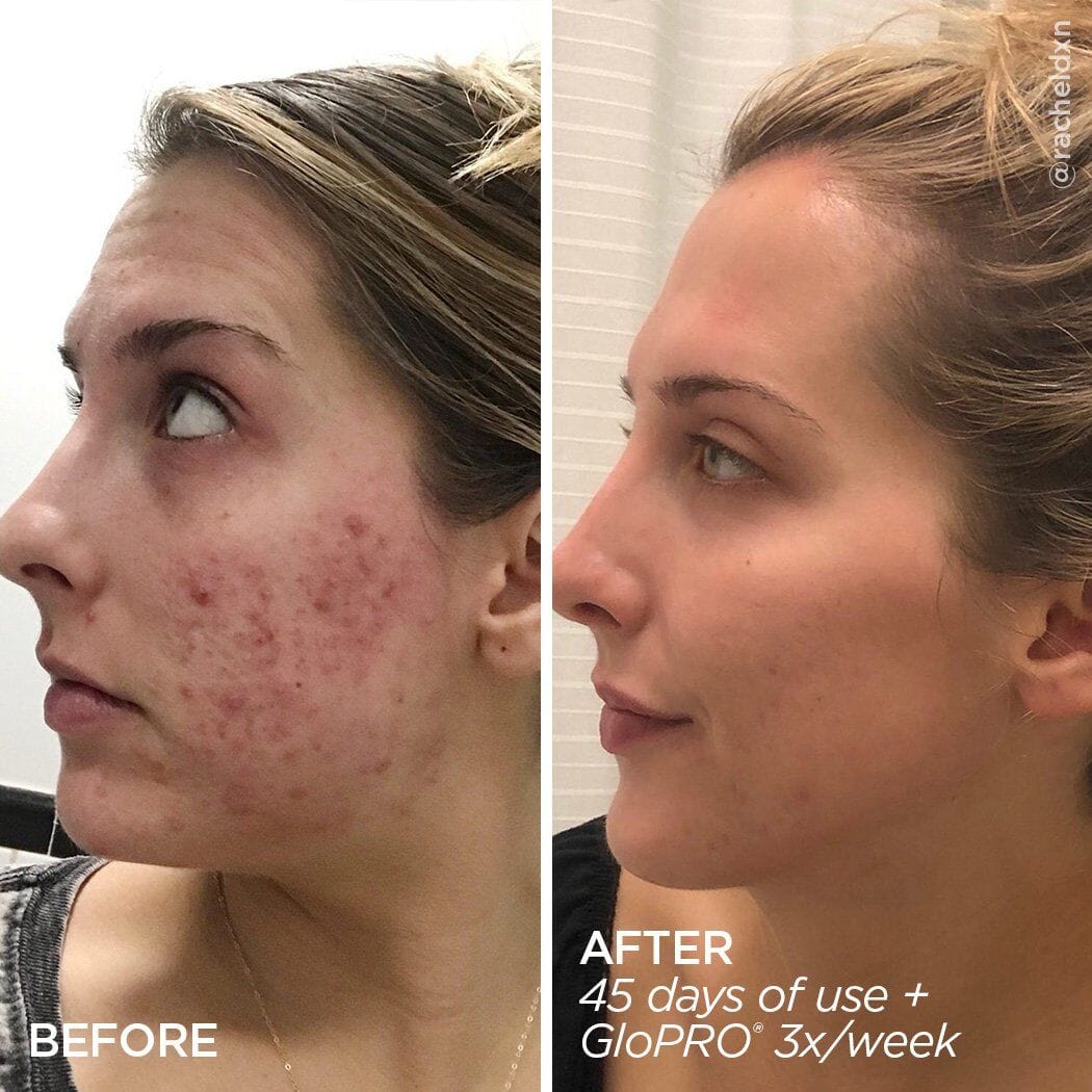 tretinoin cream before and after acne