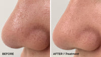 BeautyBio GLOfacial - Pore Cleansing Tool with Pro Results