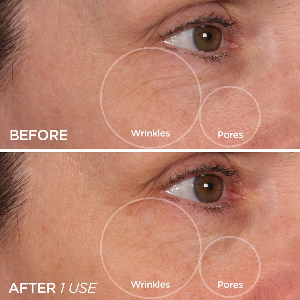 Cryo Roller Reduces Wrinkles & Tightens Pores